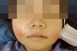 Khuôn mặt sưng tấy của người bệnh sau khi tiêm filler