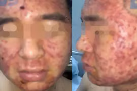 Sử dụng thuốc nam, nam thanh niên bị mụn chi chít. (Ảnh bệnh viện cung cấp) 