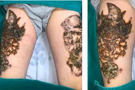 Xóa xăm ở cơ sở không an toàn dẫn đến nhiễm trùng nặng (ảnh: Lê Vinh)