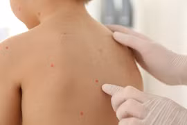 Các nốt phỏng nước nổi khắp cơ thể là biểu hiện điển hình của thủy đậu