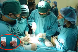Các bác sĩ phẫu thuật loại bỏ 2 khối u hình giống chiếc xúp lơ có trọng lượng 1,6 kg và 2 kg của các bệnh nhân T. và V.