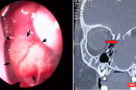 Bé trai 15 tháng tuổi bị lồi mắt, nghẹt mũi vì khối u lớn chèn ép. Ảnh: BVCC