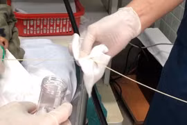 Một phần con sán dây bò được lấy ra khỏi tá tràng của bệnh nhân. Ảnh: BVCC