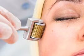 Lăn kim tại spa, một phụ nữ bị phù nề da mặt, mưng mủ. Ảnh minh họa: Internet
