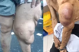 Cắt bỏ khối u sợi thần kinh khổng lồ khỏi cơ thể người đàn ông.