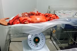 Khối u được cắt bỏ