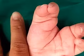 Bé trai hai tuổi vừa được các bác sĩ BV Nhi Đồng cứu thoát khỏi chứng tay chân càng cua 