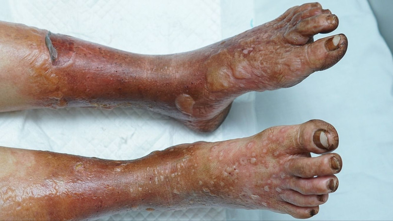 Hoại tử cả 2 chân vì ngâm bằng loại bột lá không xuất xứ