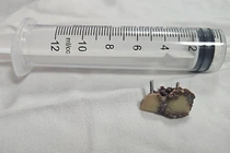 Chiếc răng giả ở trong phổi bệnh nhân 20 năm vừa được các bác sĩ Bệnh viện Đà Nẵng lấy ra.