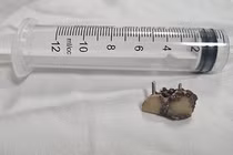 Chiếc răng giả ở trong phổi bệnh nhân 20 năm vừa được các bác sĩ Bệnh viện Đà Nẵng lấy ra.