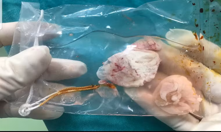 Nang sán làm tổ trong não bệnh nhân
