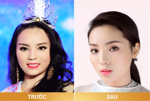 Kỳ Duyên, tiêm mũi, tiêm cằm, phẫu thuật thẩm mỹ, nói dối