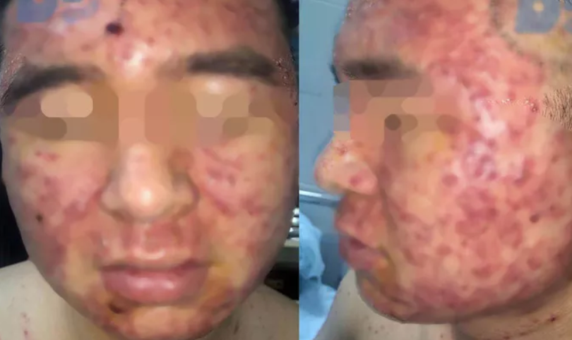 Sử dụng thuốc nam, nam thanh niên bị mụn chi chít. (Ảnh bệnh viện cung cấp) 