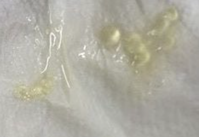 Tinh trùng bị vón cục, đặc quánh do thủ dâm quá nhiều (Ảnh: Khoa Nam học và Y học giới tính, BV ĐHY HN) Tinh trùng bị vón cục, đặc quánh do thủ dâm quá nhiều (Ảnh: Khoa Nam học và Y học giới tính, BV ĐHY HN)