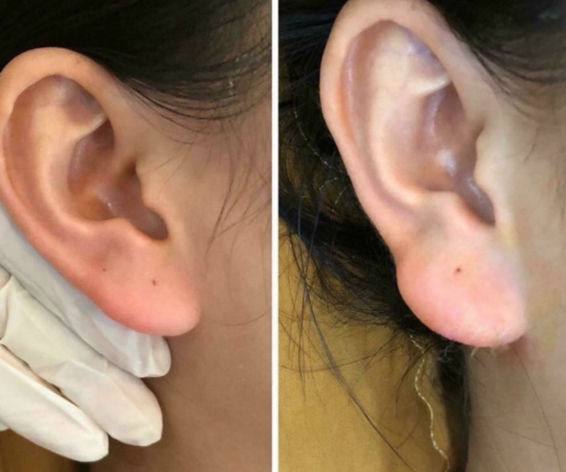 Hàng loạt spa đang quảng cáo tiêm filler dáng "tai phật" khiến nhiều người tin tưởng và quyết định đi nâng cấp đôi tai (Ảnh minh hoạ) Hàng loạt spa đang quảng cáo tiêm filler dáng "tai phật" khiến nhiều người tin tưởng và quyết định đi nâng cấp đôi tai (Ảnh minh hoạ)