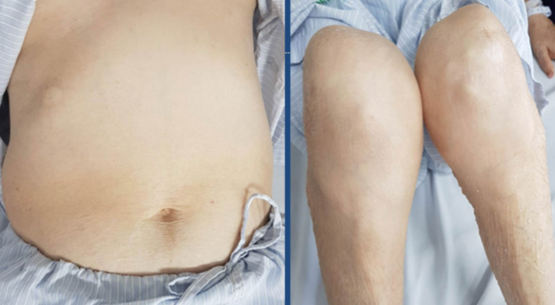 Một bệnh nhân bị teo cơ tứ chi, béo bụng, rạn da vùng bụng, da mỏng, dễ xuất huyết vì lạm dụng corticoid để trị đái tháo đường (Ảnh: BV Bạch Mai) Một bệnh nhân bị teo cơ tứ chi, béo bụng, rạn da vùng bụng, da mỏng, dễ xuất huyết vì lạm dụng corticoid để trị đái tháo đường (Ảnh: BV Bạch Mai)