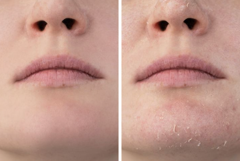 Da bị ảnh hưởng vì mặc quá ấm trong thời gian dài (Ảnh: Brightside)