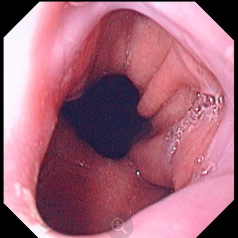 Hình ảnh thoát vị hoành (Ảnh - BS. David M. Martin) Hình ảnh thoát vị hoành (Ảnh - BS. David M. Martin)
