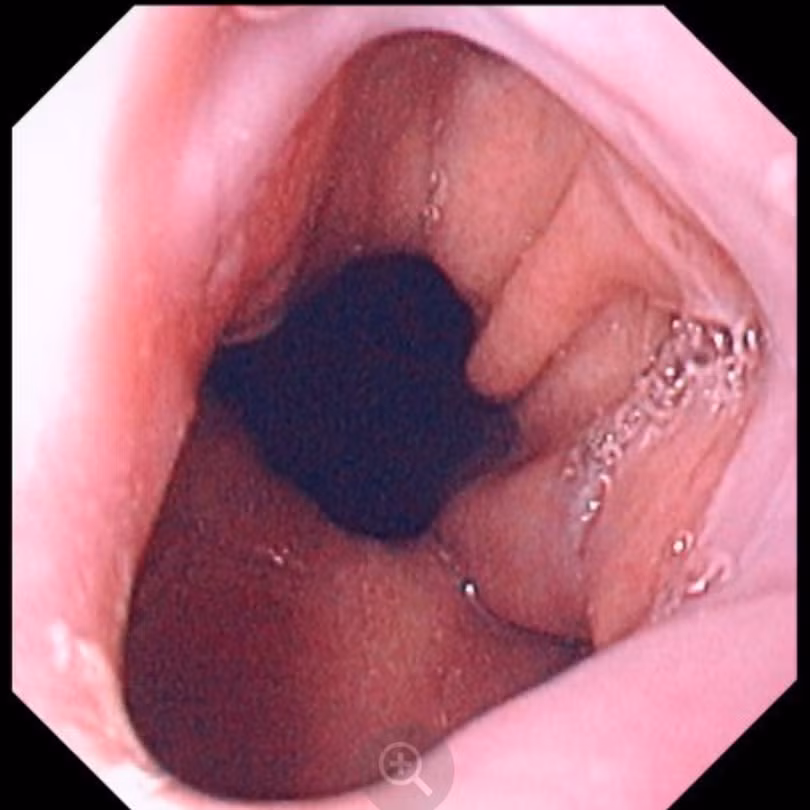 Hình ảnh thoát vị hoành (Ảnh - BS. David M. Martin)