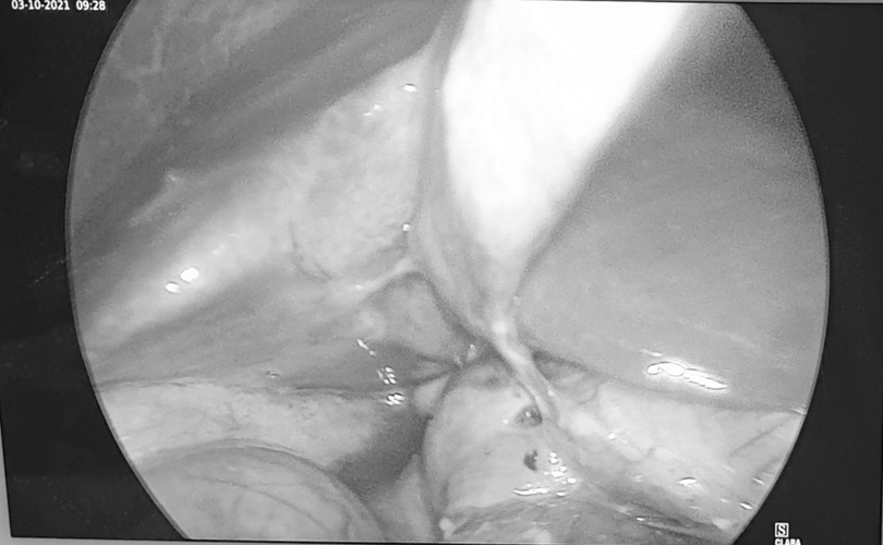 Hình ảnh lỗ thủng hành tá tràng qua nội soi của bệnh nhân (Ảnh - BSCC) Hình ảnh lỗ thủng hành tá tràng qua nội soi của bệnh nhân (Ảnh - BSCC)