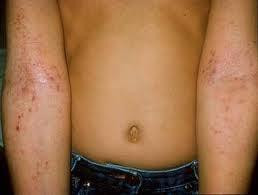 Hình ảnh da trẻ bị viêm da cơ địa (Ảnh - BVCC) Hình ảnh da trẻ bị viêm da cơ địa (Ảnh - BVCC)