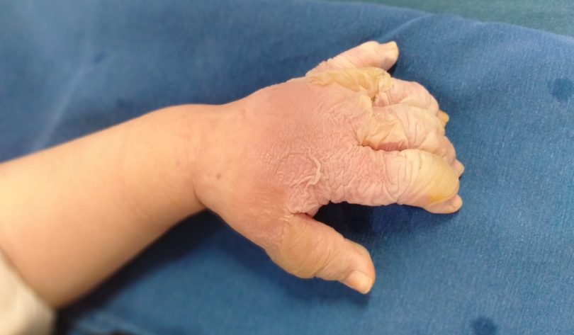 Hình ảnh bàn tay của trẻ bị bỏng nước sôi (Ảnh - BVCC) Hình ảnh bàn tay của trẻ bị bỏng nước sôi (Ảnh - BVCC)