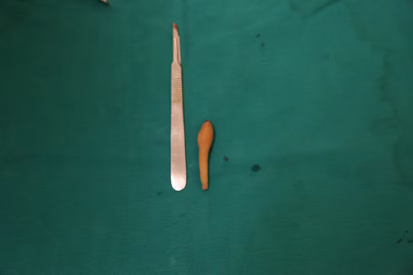 Đuôi của bé gái 5 tháng tuổi. Ảnh: BVCC