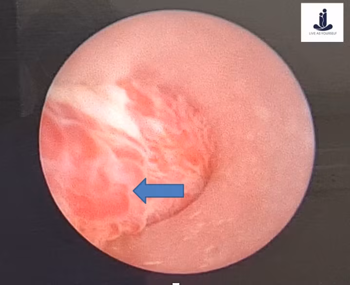 Hình ảnh đám mạch máu niệu đạo giãn lớn qua nội soi niệu đạo ngược dòng (Ảnh - Khoa Nam học và Y học Giới tính)