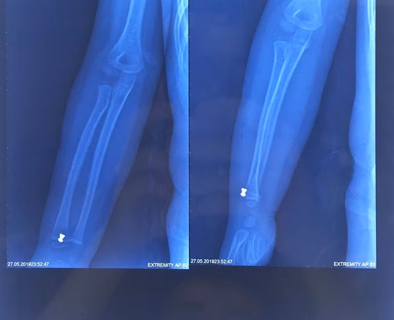 Hình ảnh đạn súng hơi găm trong tay bệnh nhi