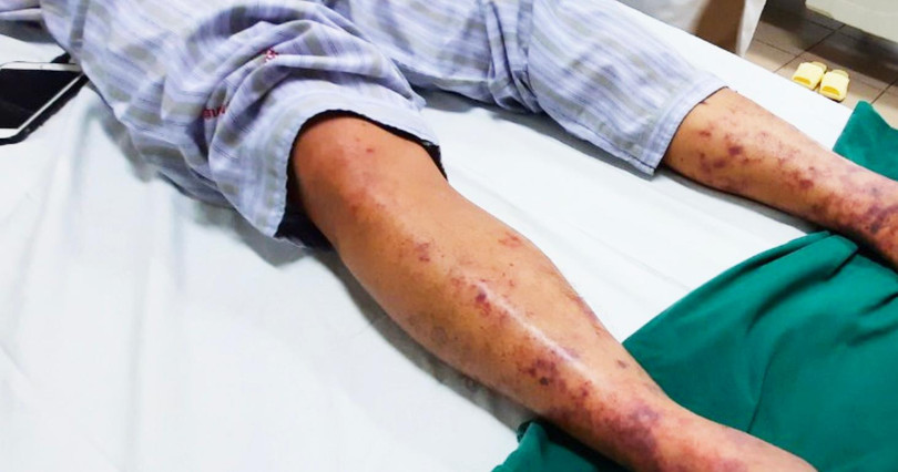 Hình ảnh da của bệnh nhân mắc liên cầu lợn (Ảnh - Đặng Thanh) Hình ảnh da của bệnh nhân mắc liên cầu lợn (Ảnh - Đặng Thanh)