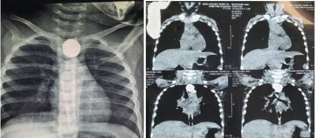 Hình ảnh chụp Xquang của bệnh nhi (Ảnh - BVCC) Hình ảnh chụp Xquang của bệnh nhi (Ảnh - BVCC)