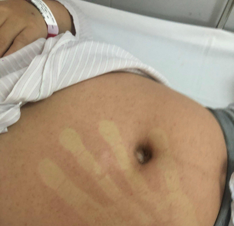 Hình ảnh ban đỏ ở bệnh nhân sốt xuất huyết (Ảnh - BVCC)