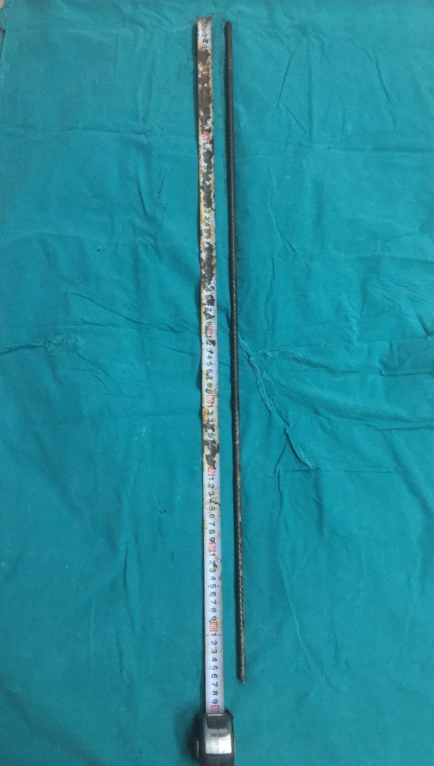 Thanh sắt đâm xuyên từ cổ qua não của bệnh nhân (Ảnh - BVCC)