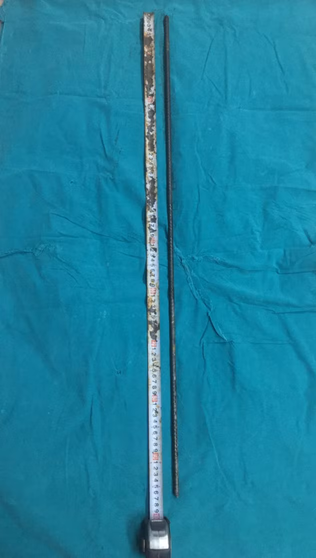 Thanh sắt đâm xuyên từ cổ qua não của bệnh nhân (Ảnh - BVCC)