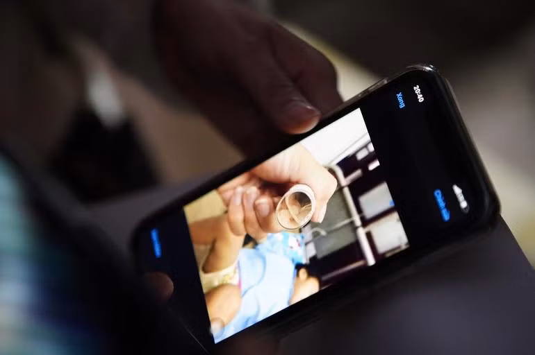 Hình ảnh dị vật ở mũi bé A. trong lần điều trị tại Bệnh viện Nhi Trung ương.