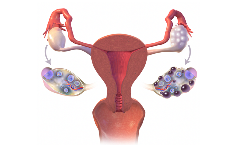 Hình ảnh so sánh buồng trứng đa nang (bên phải) và buồng trứng bình thường (bên trái) (Ảnh - BVCC)