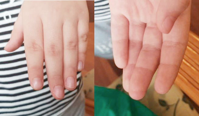 Hình ảnh búp ngón tay của bệnh nhi sau mổ. Ảnh: BVCC