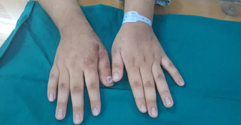 Bàn tay của bệnh nhân sau phẫu thuật (Ảnh: BVCC) 