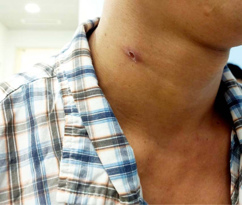Vết thương do đạn bắn trên cổ bệnh nhân (Ảnh: BVCC)