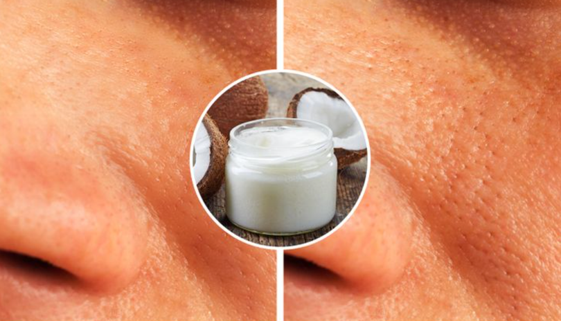 Bôi dầu dừa thay vì kem dưỡng ẩm có thể gây bít lỗ chân lông (Ảnh: BrightSide)