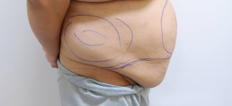 Mỡ bụng của chị H. trước khi phẫu thuật (Ảnh: BS. Nguyễn Đình Minh)