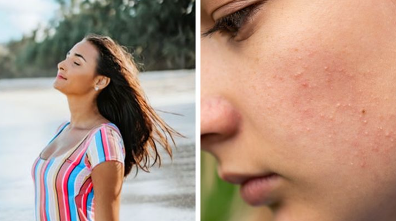 Rám nắng không làm sạch mụn (Ảnh: BrightSide) Rám nắng không làm sạch mụn (Ảnh: BrightSide)