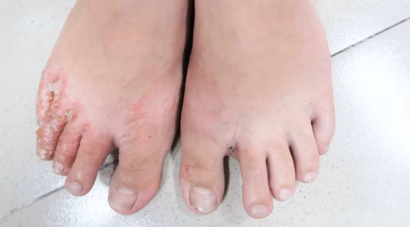 Bệnh nhân bị nấm chân (Ảnh: BS. Lê Thị Mai) 