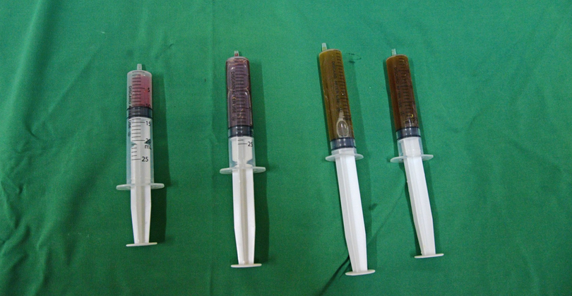 Dịch máu được hút ra từ nang giáp của bệnh nhân (Ảnh: BVCC)