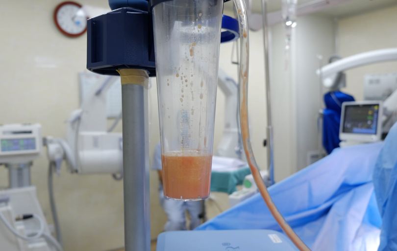 Mỡ được hút ra từ cơ thể của cô gái 22 tuổi (Ảnh: BS. Nguyễn Đình Minh)