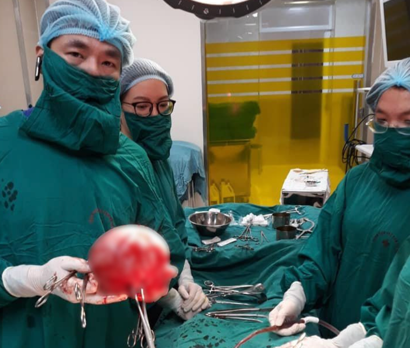 Bác sĩ cắt bỏ khối u xơ (Ảnh: BVCC) 