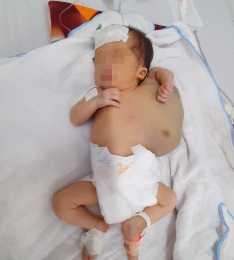 Khối u khổng lồ chèn ép cơ thể bé (Ảnh - BVCC)