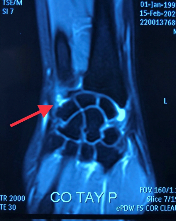 Hình ảnh tổn thương phức hợp dây chằng sụn sợi tam giác TFCC trên phim MRI (Ảnh - BVCC)