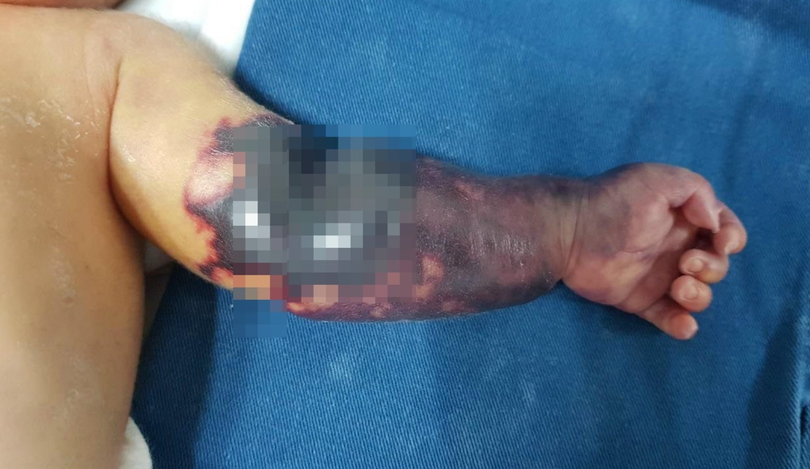 Hình ảnh cánh tay bé T. khi mới vào viện (Ảnh - BVCC) 