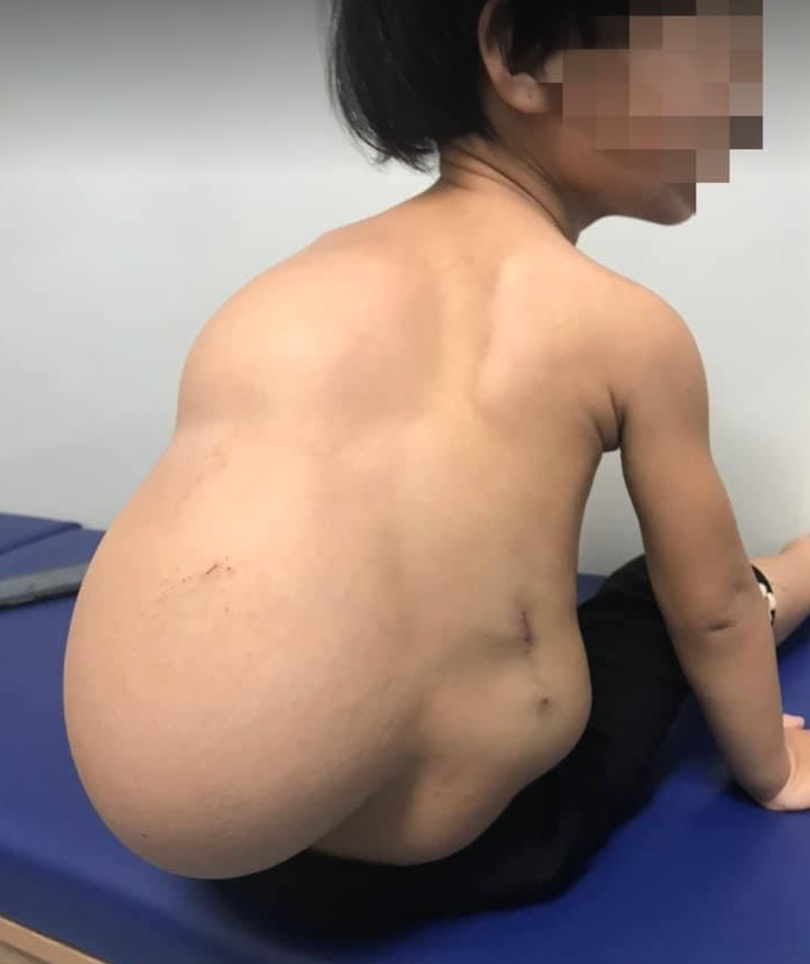 Bé V. với khối u to khổng lồ trước khi phẫu thuật (Ảnh: BVCC)